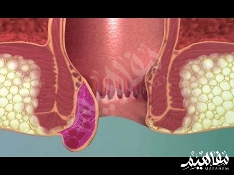 شكل البواسير الخارجية شكل البواسير الخارجية