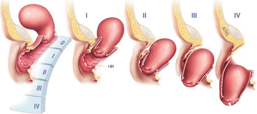 هبوط الرحم بالصور حقيقية هبوط الرحم بالصور حقيقية