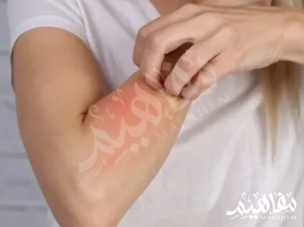 ديرموفيت لحساسية ديرموفيت لحساسية