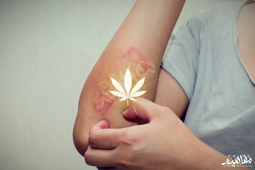 ديرموفت والاكزيما ديرموفت والاكزيما