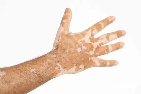 ديمفيت والبهاق ديمفيت والبهاق