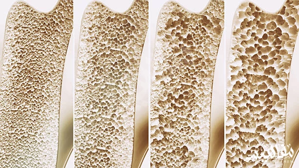 Osteoporosis 2 Osteoporosis 2