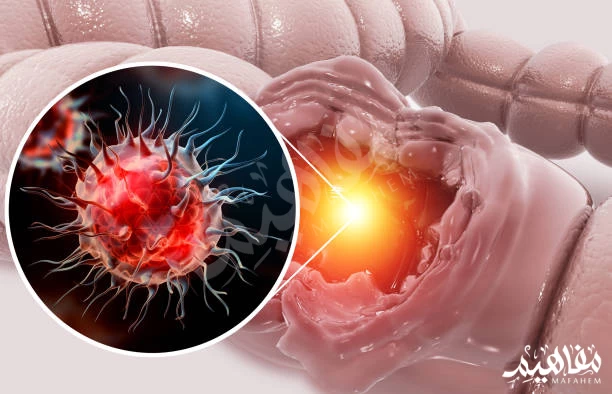 البنكرياس سرطان البنكرياس سرطان