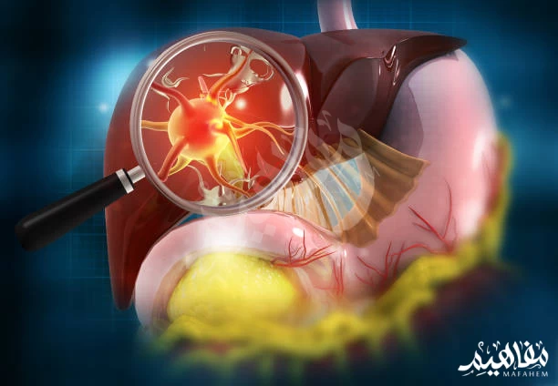 ورم البنكرياس ورم البنكرياس