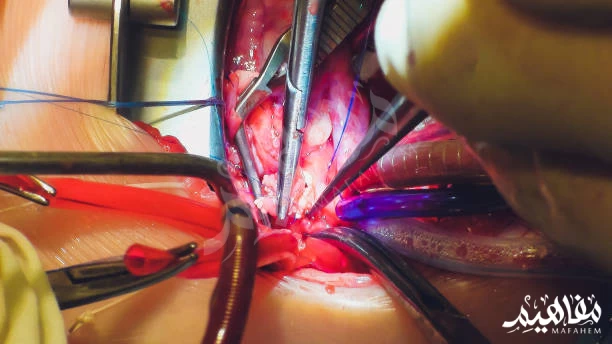 سرطان البنكرياس سرطان البنكرياس