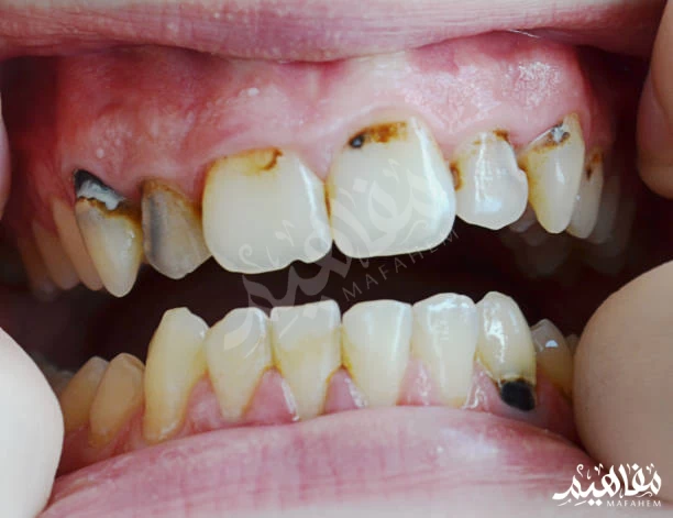 تسوس الاسنان تسوس الاسنان