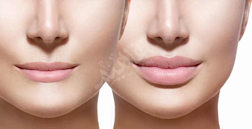 lips filler lips filler