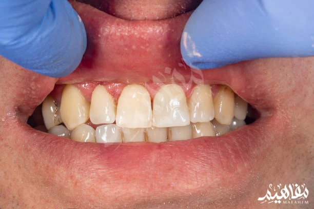 gum cancer gum cancer