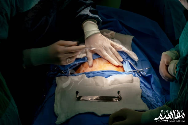 Anesthesia for cesarean delivery Anesthesia for cesarean delivery