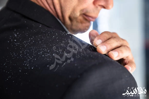 Dandruff قشره الشعر Dandruff قشره الشعر