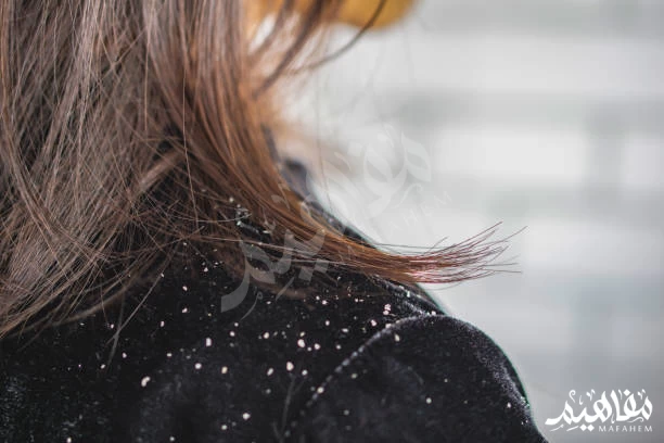 قشره الشعر Dandruff قشره الشعر Dandruff