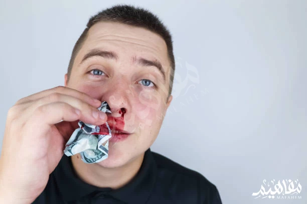 a nosebleed a nosebleed