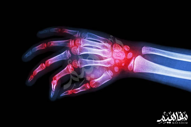 fish treat arthritis fish treat arthritis