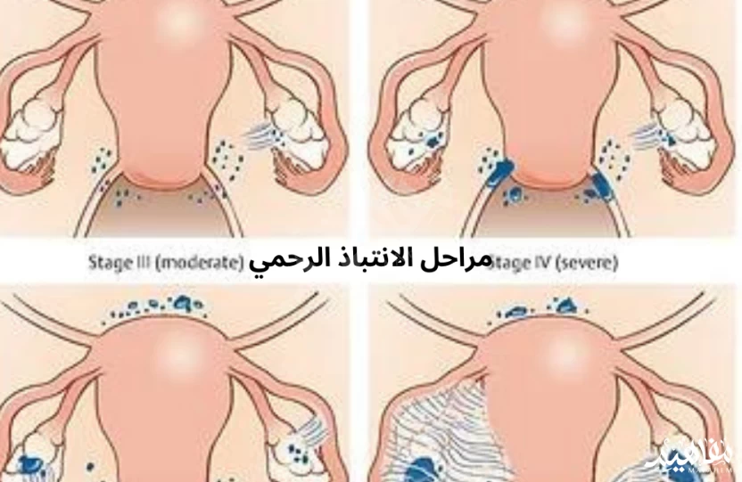 Endometriosis Endometriosis