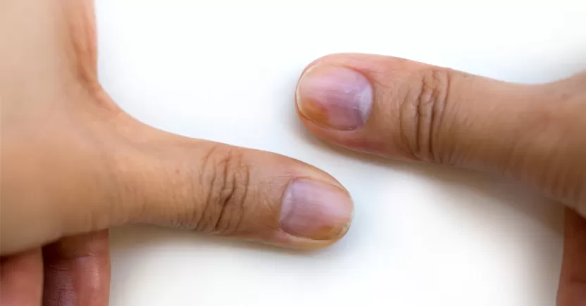 الأظافر الزرقاء الأظافر الزرقاء