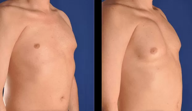 شكل الثدي عند ارتفاع هرمون الحليب شكل الثدي عند ارتفاع هرمون الحليب