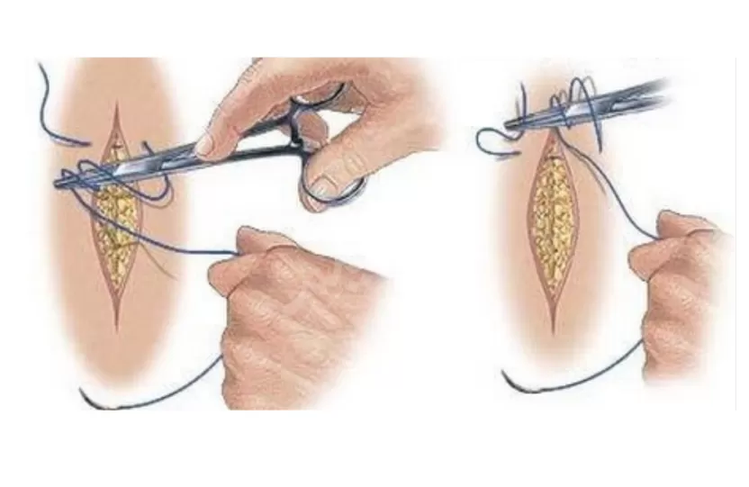 شكل الختان الفرعوني شكل الختان الفرعوني