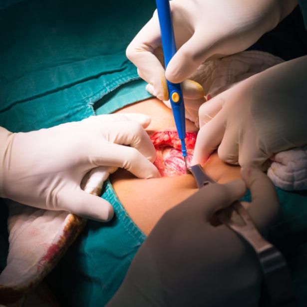 الزائدة الدودية الزائدة الدودية