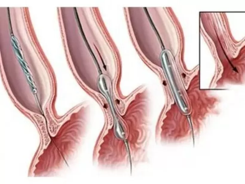 عملية التنظيف للرحم عملية التنظيف للرحم
