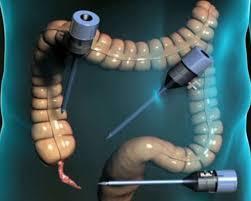 الزائدة الدودية الزائدة الدودية