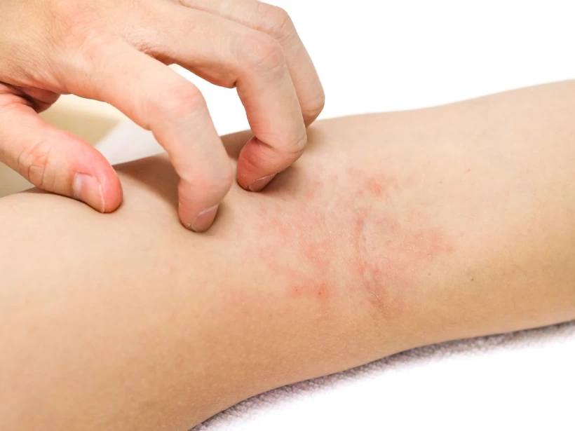 الشري التحسسي الشري التحسسي