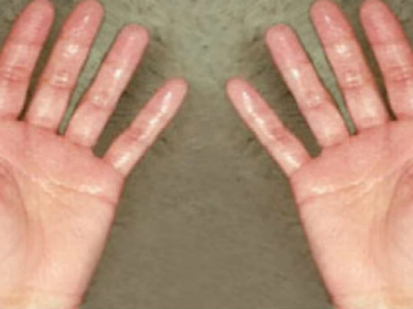 تعرق-اليد تعرق-اليد