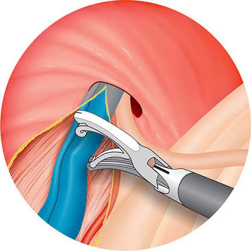 تقنيات عملية دوالي الخصية تقنيات عملية دوالي الخصية