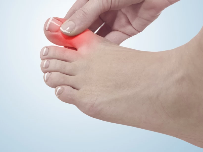 داء الملوك النقرس داء الملوك النقرس